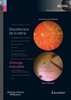 ebook - Décollement de la rétine / Chirurgie maculaire